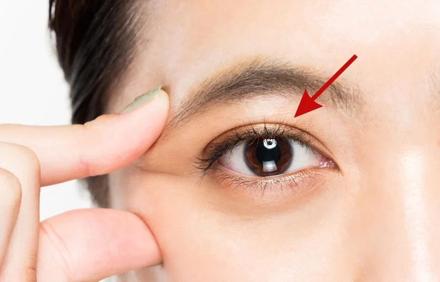 Who Should Get Double Eyelid Surgery? Is It Safe?