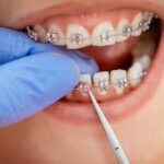 Orthodontics for Adults: It’s Never Too Late to Straighten Your Teeth