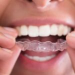 Orthodontic Retainers: Why They’re Important and How to Care for Them