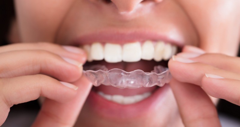 Orthodontic Retainers: Why They’re Important and How to Care for Them