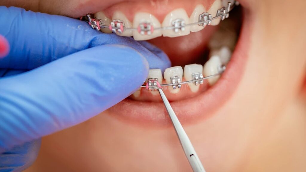 Life with Braces: Tips from Orthodontists for Maintaining Oral Hygiene and Comfort