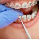 Life with Braces: Tips from Orthodontists for Maintaining Oral Hygiene and Comfort