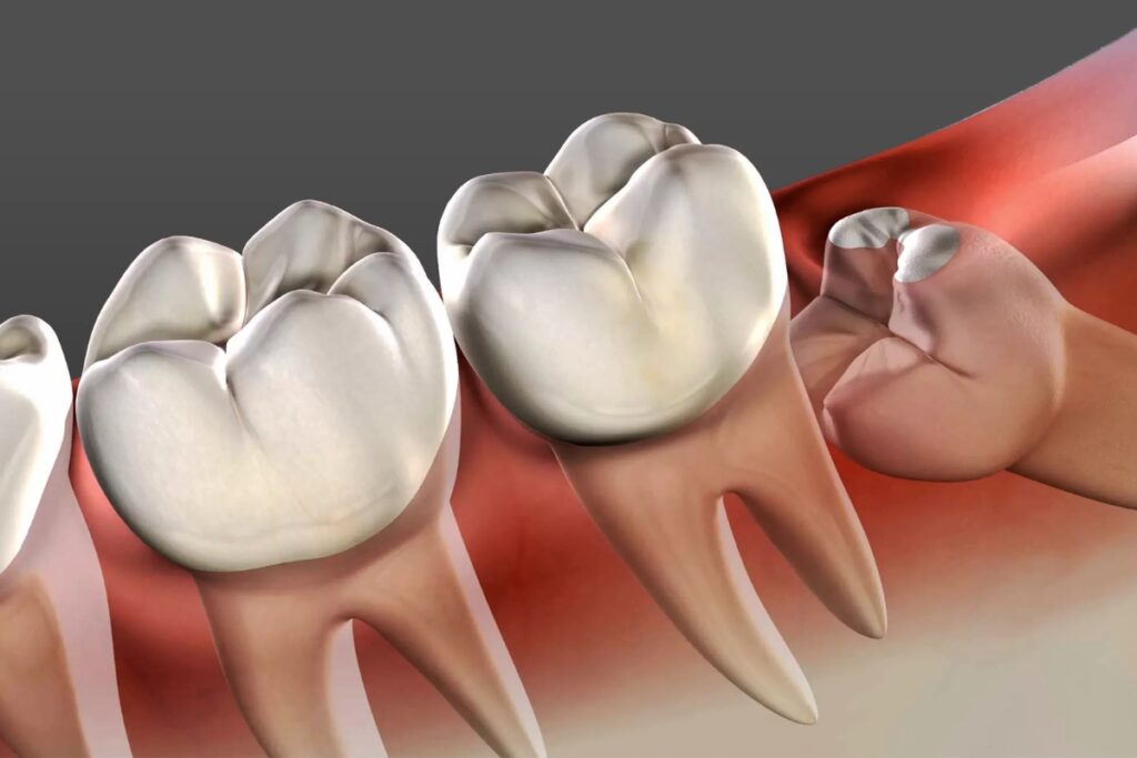 WISDOM TOOTH EXPLAINED: WHEN REMOVAL BECOMES NECESSARY?